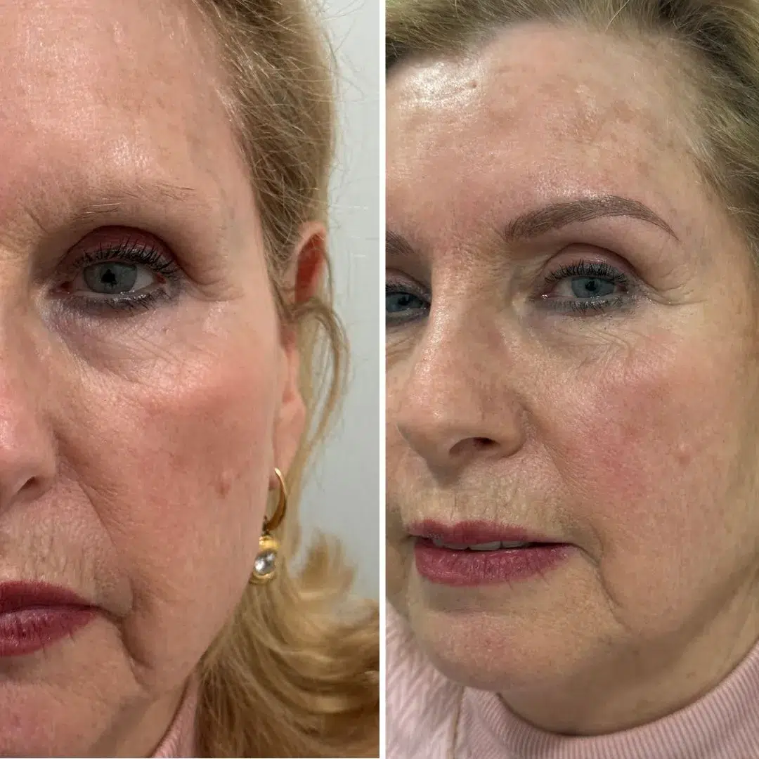 Caso real: alopecia total, diseño completo de cejas
