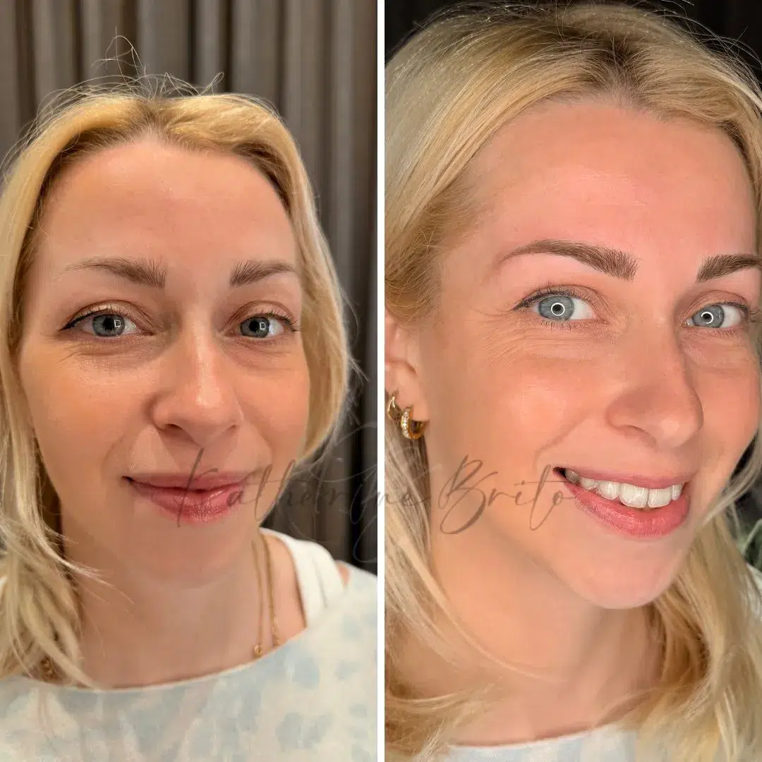 Caso real: reconstrucción de cejas por alopecia parcial