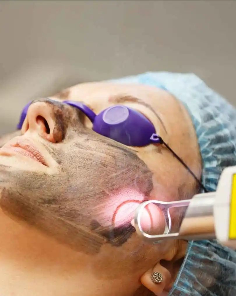 Antes y después limpieza facial profunda Barcelona