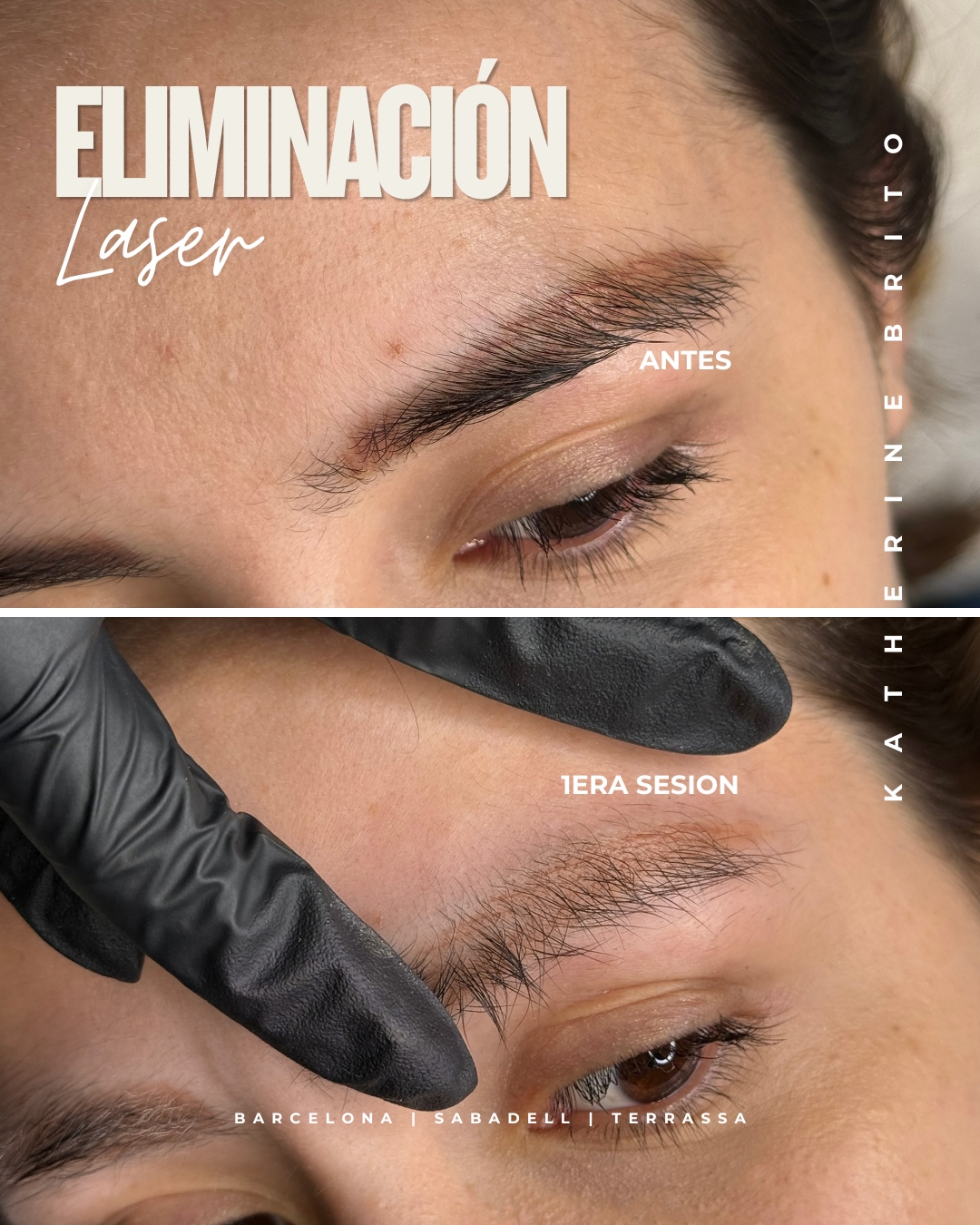 Antes y después de eliminación láser de cejas Barcelona