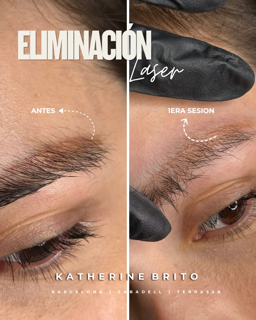 Primera sesión de eliminación láser de cejas en Barcelona