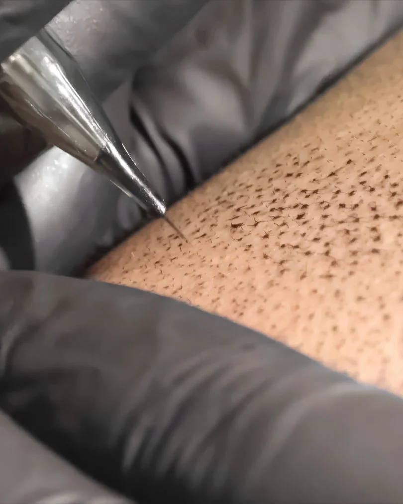 Detalle de micropuntos de tricopigmentación en Barcelona