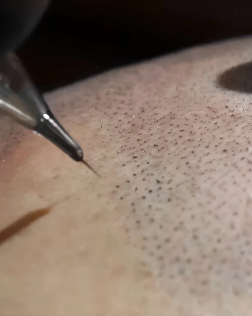 Tricopigmentación en Barcelona, densidad capilar natural